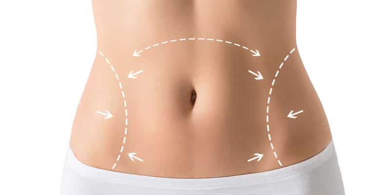 Abdominoplastie-Tunisie-Ventre