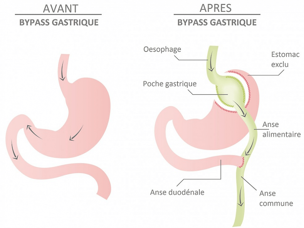 Bypass Gastrique En Tunisie Dossier Complet Tunisie Esthetique