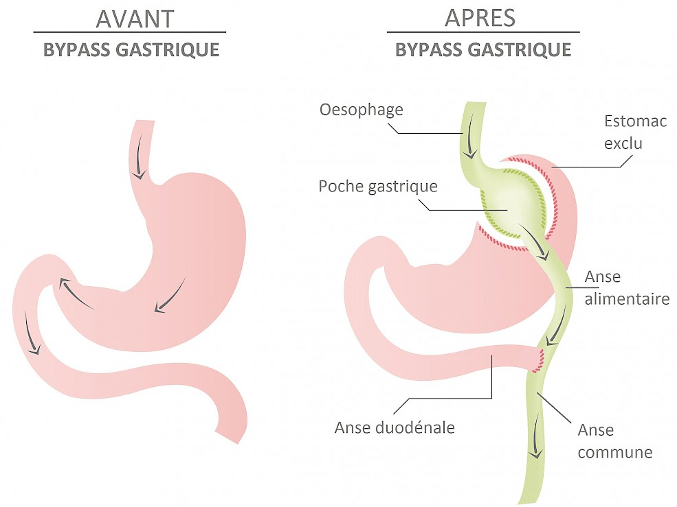 Explication-Bypass-gastrique-tunisie