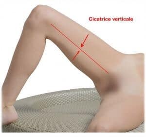 Cicatrice-lifting-des-cuisses