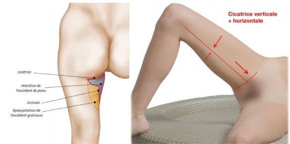 Lifting-des-cuisses-3