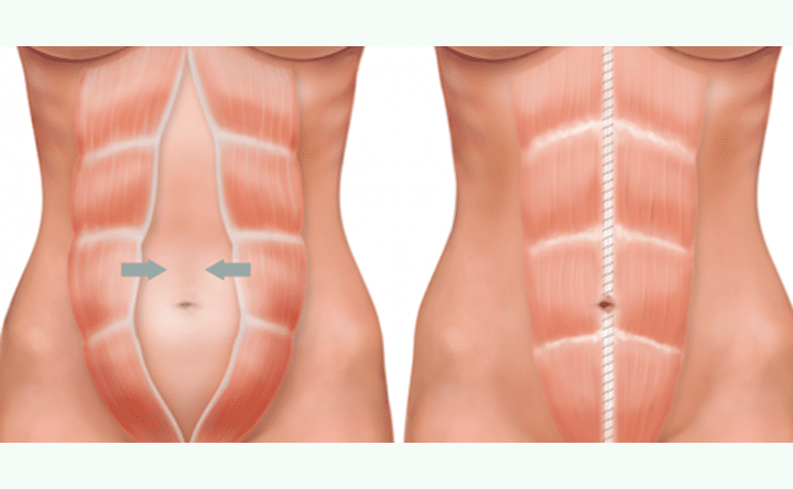 Muscles-abdomen-abdominoplastie-Tunisie