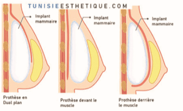 position-implant-augmentation-mammaire-tunisie