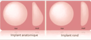 Types-implants-augmentation-mammaire-tunisie