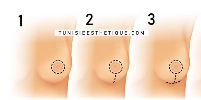 Cicatrices-reduction-mammaire-tunisie