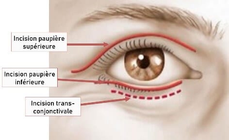 Blepharoplastie-tunisie