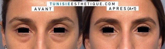 Blepharoplastie-photo-avant-apres-1