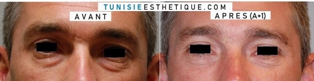 Blepharoplastie-photo-avant-apres-1