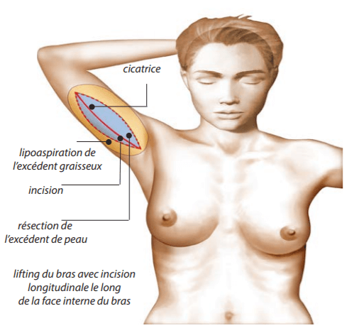 Cicatrice-lifting-bras