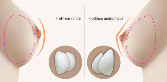 Ronde-Vs-Anatomique-Augmentation-Mammaire-Tunisie