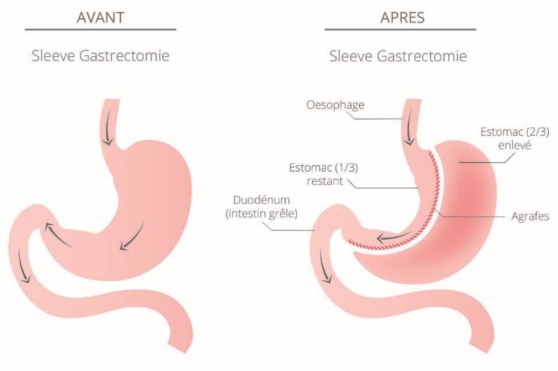 Explication-Sleeve-Tunisie