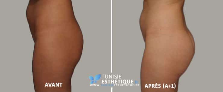 Photo-avant-apres-implant-fesse-tunisie