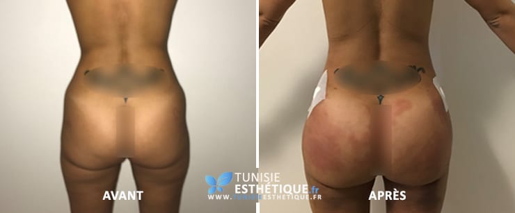 Injection-graisse-fesse-tunisie-1