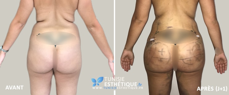 Liposuccion-injection-graisse-fessier-tunisie