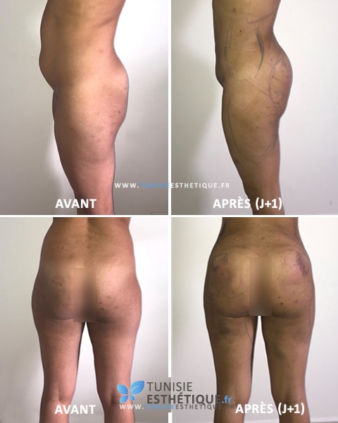 Liposuccion-ventre-injection-graisse-fessier-Tunisie