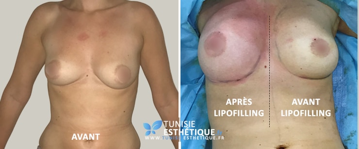 Exemple-lipofilling-mammaire-tunisie-sein-droite-vs-gauche
