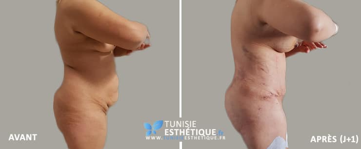 Abdominoplastie-Tunisie-photo-avant-apres-3