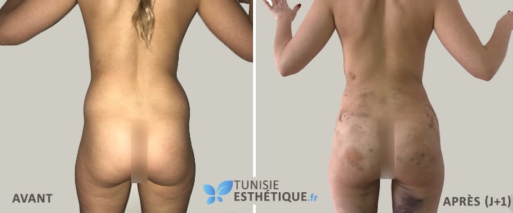 Liposuccion-Lipofilling-fesses-Tunisie