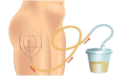 Liposuccion Tunisie : conseils pour maintenir sa silhouette après l’opération