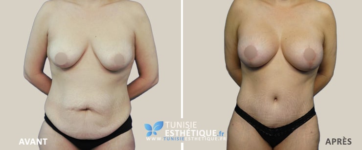 Abdominoplastie-Tunisie-photo-avant-apres-5