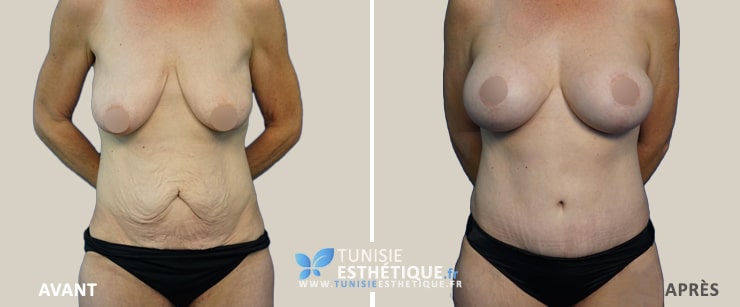 Abdominoplastie-Tunisie-photo-avant-apres-6