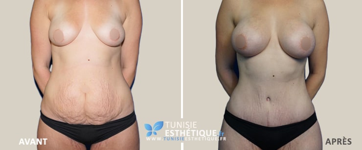 Abdominoplastie-Tunisie-photo-avant-apres-4