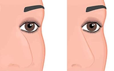 Corriger les défauts et problèmes de son nez grâce à la rhinoplastie