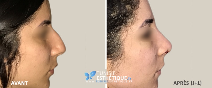 Rhinoplastie-tunisie-avant-apres-1