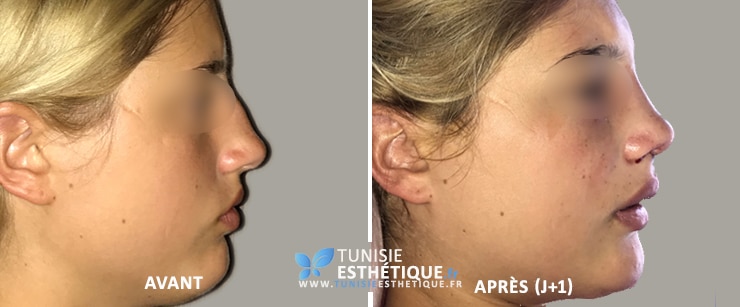 Rhinoplastie-tunisie-avant-apres-3