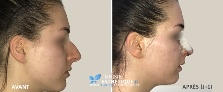 Rhinoplastie-tunisie-avant-apres-2