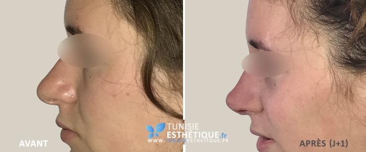 Rhinoplastie-tunisie-avant-apres-4