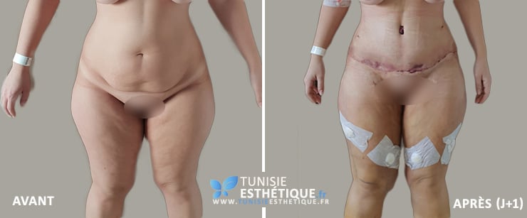 Abdominoplastie-Tunisie-photo-avant-apres-2