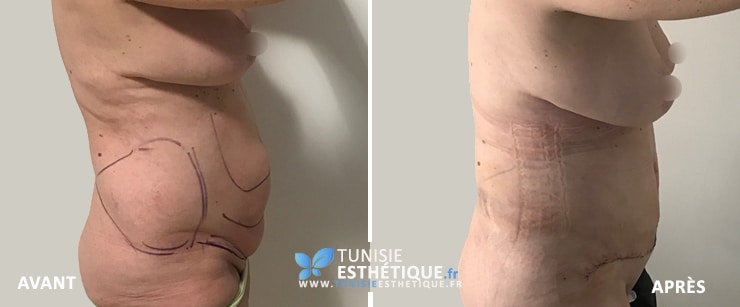 Abdominoplastie-Tunisie-photo-avant-apres-1