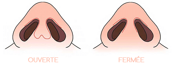 Rhinoplastie-Tunisie-ouverte-fermee