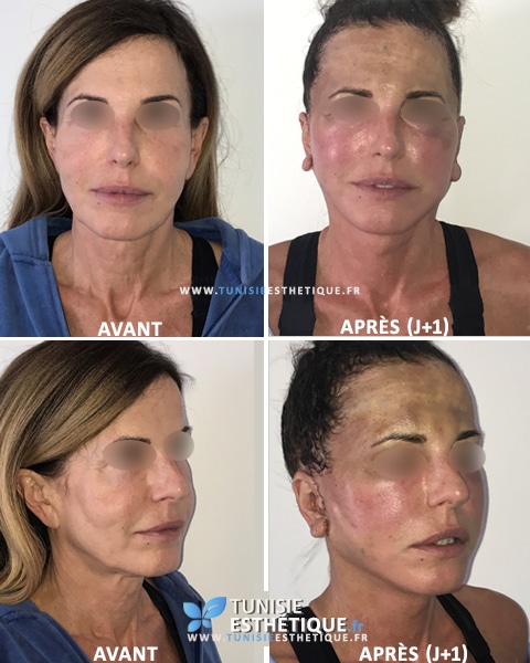 Lipofilling-visage-avant-apres