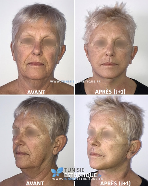 Lifting-visage-photos-avant-apres-2