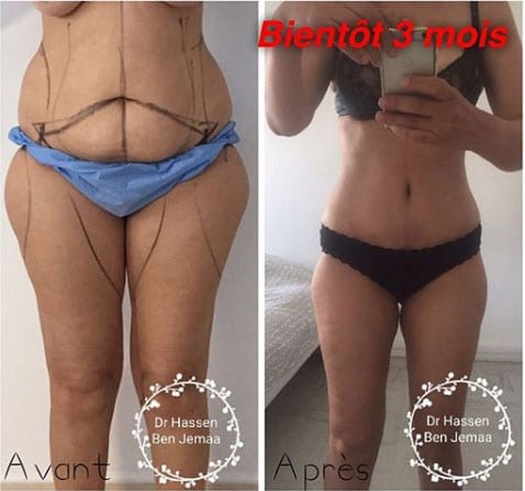 Liposuccion-Abdominoplastie-Dr-Ben-Jemaa-Tunisie