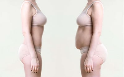 Liposuccion : une solution pour maigrir?