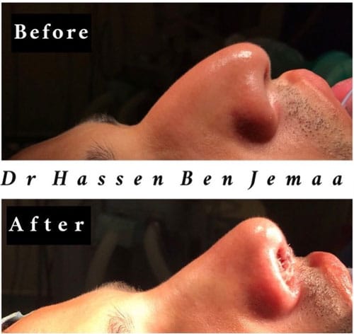 Liposuccion-Lipofilling-Fesses-Tunisie-2-Dr-Ben-Jemaa