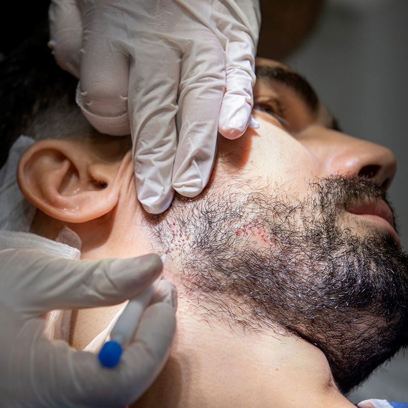 Greffe-de-barbe-article-Tunisie-esthetique-3