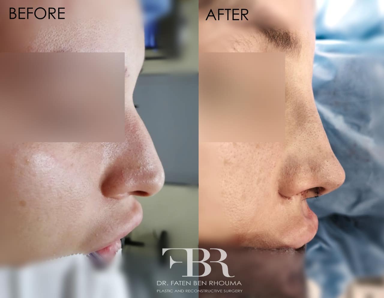 Rhinoplastie-photo-avant-apres-Dr-Ben-Rhouma