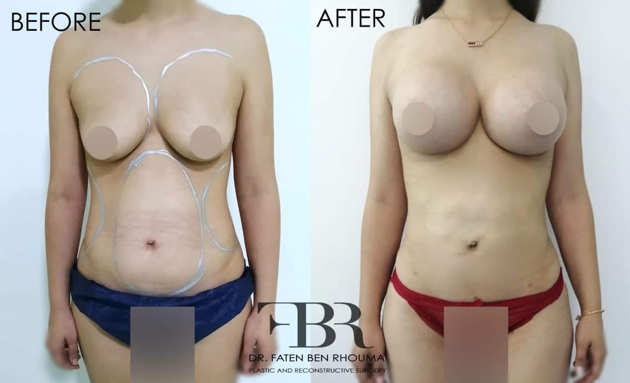 Liposuccion-augmentation-mammaire-photo-avant-apres-Dr-Ben-Rhouma