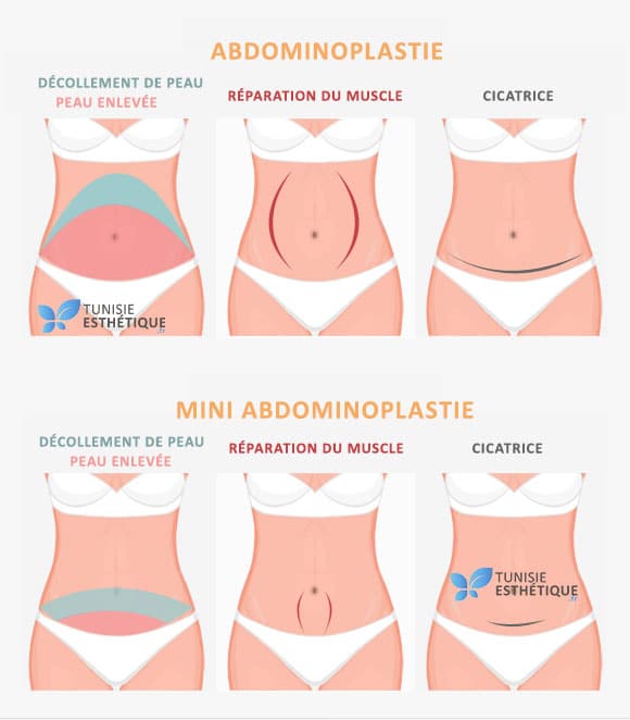 Abdo-ou-mini-abdominoplastie-Tunisie