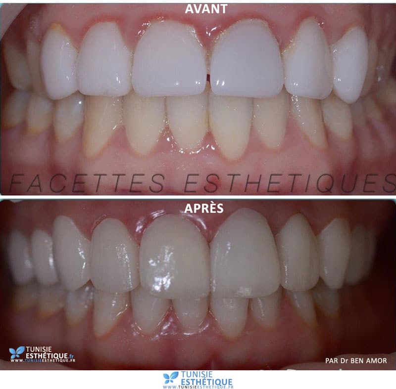 Pose Facette Dentaire Tunisie, Prix Pas Cher! Tout savoir: Tarifs € Photos  Dentiste