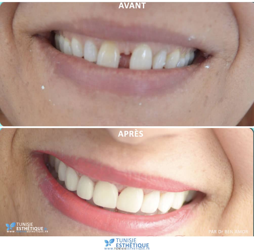 facette-dentaire-tunisie-avant-apres-4