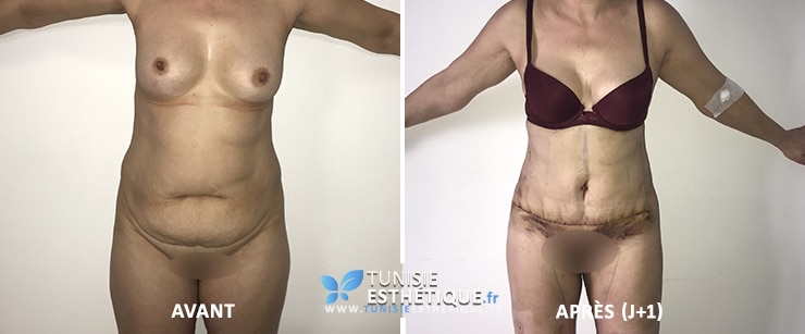 Liposuccion-ventre-cuisses-et-abdominoplastie-avant-apres-tunisie-esthetique