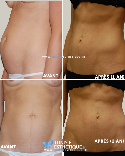 mini-abdominoplastie-tunisie-avant-apres