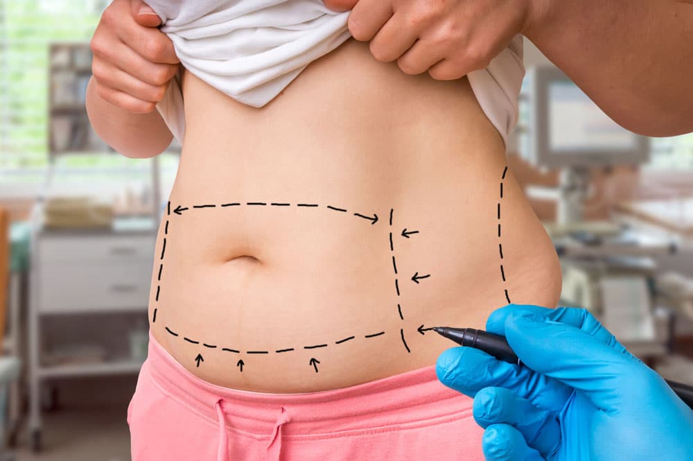 Mini-abdominoplastie-Tunisie