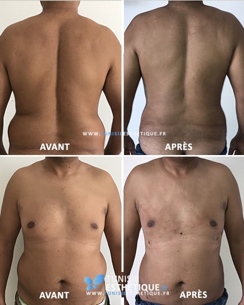 Liposuccion-ventre-homme-Tunisie-Esthetique-Avant-Apres