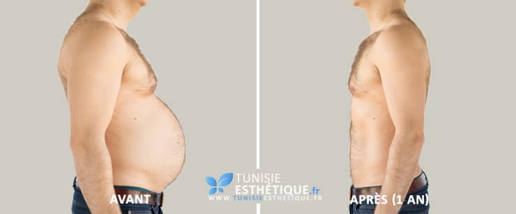 Liposuccion-ventre-homme-Tunisie-Esthetique-Avant-Apres2